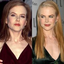 Nicole-Kidman-botox-platic-surgery.jpg